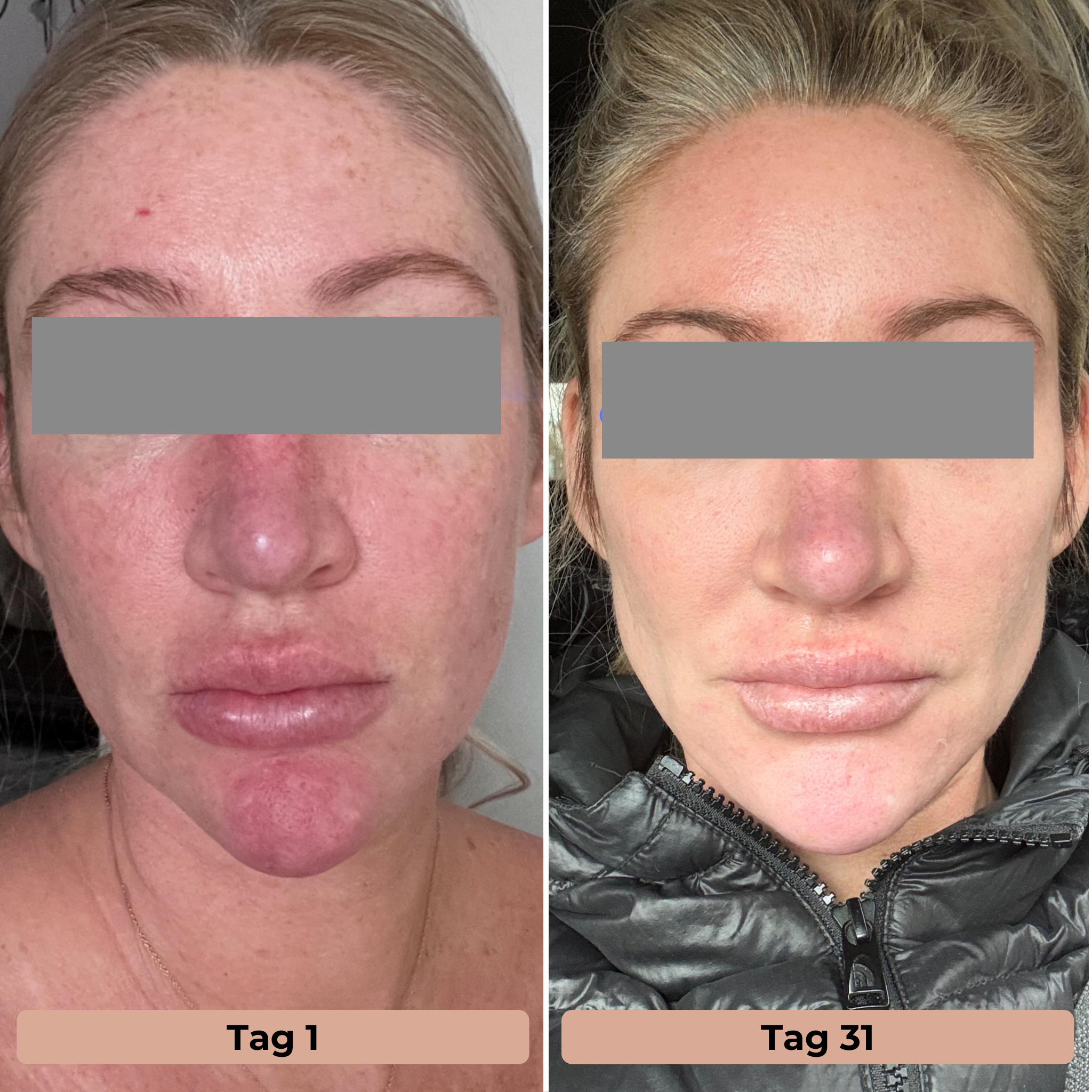 LED Lichttherapie-Maske